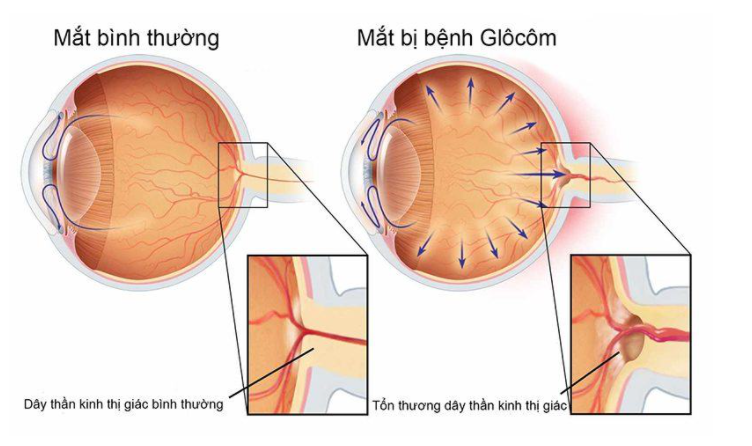 Minh họa cấu trúc góc tiền phòng mắt bị bất thường gây tăng nhãn áp bẩm sinh ở trẻ nhỏ