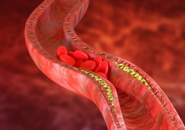 Cholesterol, mỡ máu cao gây bệnh gì?